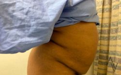 Tummy Tuck