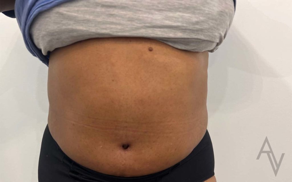 Tummy Tuck