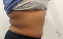 Tummy Tuck