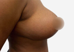 Breast Reduction