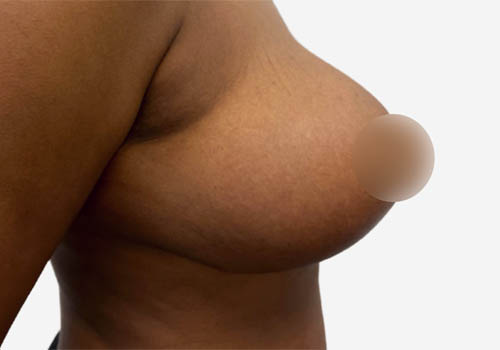 Breast Reduction