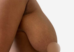 Breast Reduction