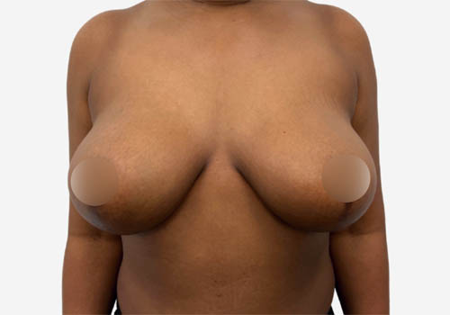 Breast Reduction