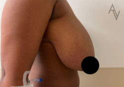 Breast Reduction