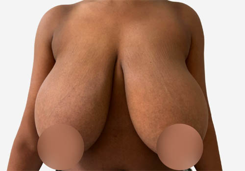 Breast Reduction
