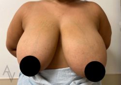 Breast Reduction