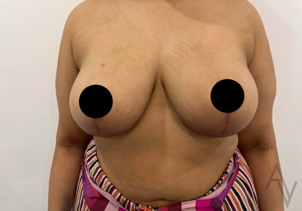 Breast Reduction