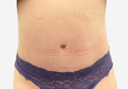 Tummy Tuck