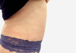 Tummy Tuck