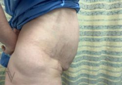 Tummy Tuck