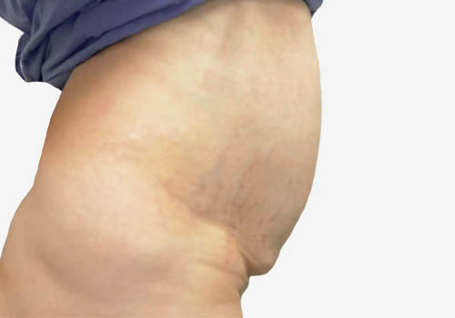 Tummy Tuck