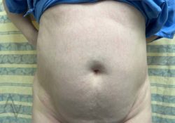 Tummy Tuck