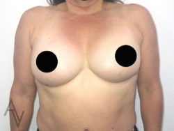 Breast Augmentation