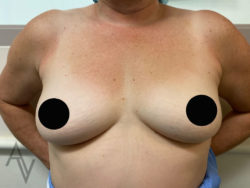 Breast Augmentation