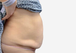 Tummy Tuck