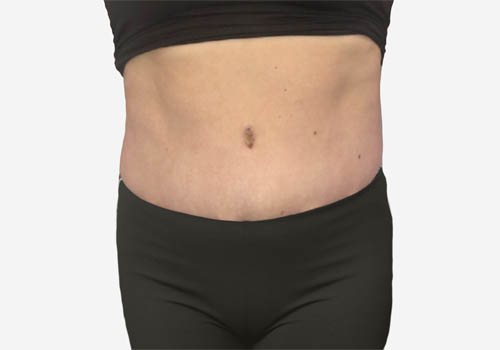 Tummy Tuck