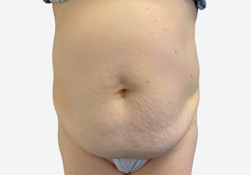 Tummy Tuck