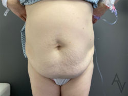 Tummy Tuck