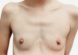 Breast Augmentation