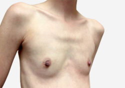 Breast Augmentation