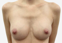 Breast Augmentation