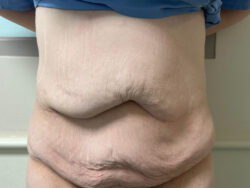 Tummy Tuck