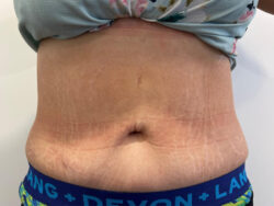 Tummy Tuck