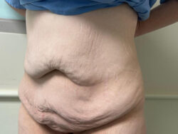 Tummy Tuck