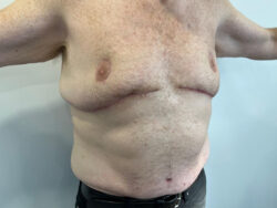 Tummy Tuck