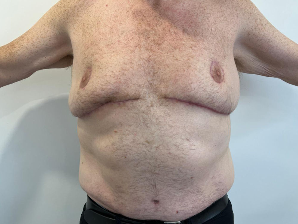 Tummy Tuck Case 17956 After Photo Tummy Tuck