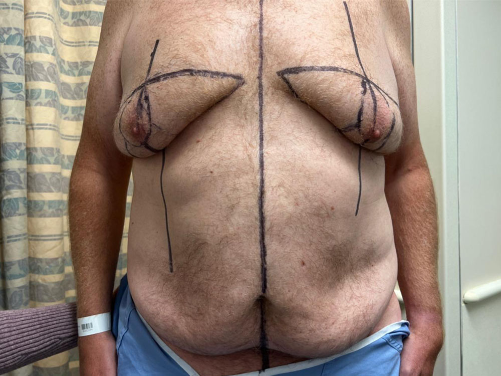 Tummy Tuck Case 17956 Before Photo Tummy Tuck