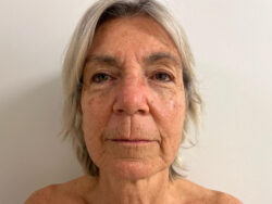 Face & Neck Lift