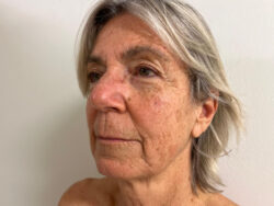 Face & Neck Lift