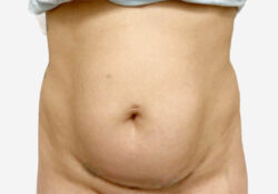 Tummy Tuck