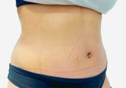 Tummy Tuck