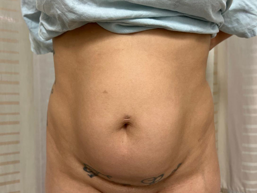 Tummy Tuck