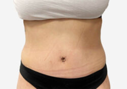Tummy Tuck