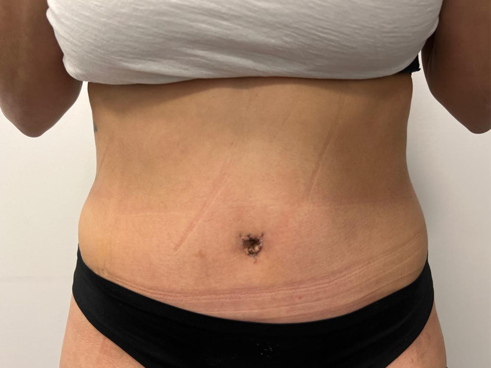 Tummy Tuck