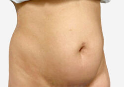 Tummy Tuck