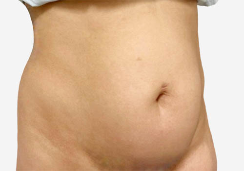 Tummy Tuck
