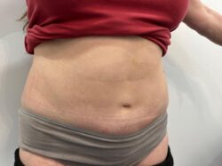 Tummy Tuck