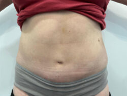 Tummy Tuck