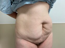 Tummy Tuck