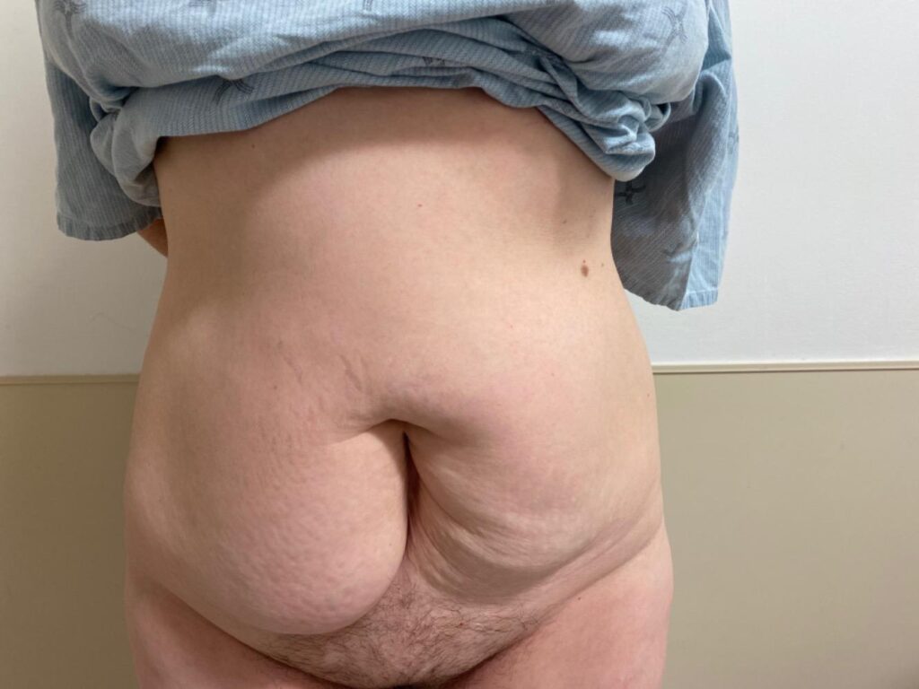 Tummy Tuck