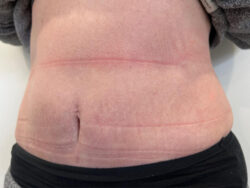 Tummy Tuck