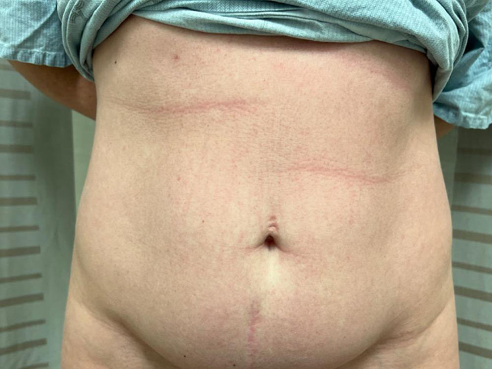 Tummy Tuck Case 18025 Before Photo Tummy Tuck