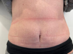 Tummy Tuck