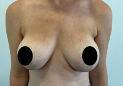 Breast Augmentation