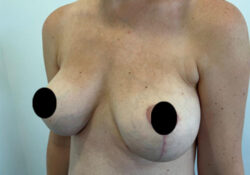 Breast Augmentation