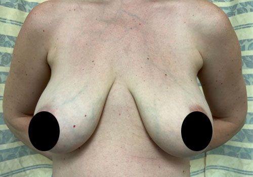 Breast Lift